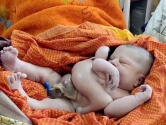 Вважають втіленням бога Вішну: в Індії народилася дитина з чотирма руками та ногами