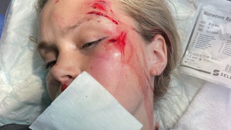 «Мало що пам'ятаю»: учасниця Олімпійських ігор у Пекіні потрапила у серйозну аварію на велосипеді