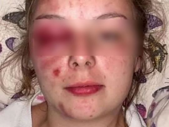 Обмовлені намагалися вчинити суїцид: жінка била себе молотком, щоб звинуватити чоловіків у зґвалтуванні