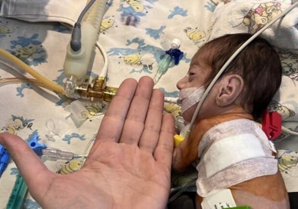 В Одессе прооперировали двух грудных детей с врожденными пороками сердца