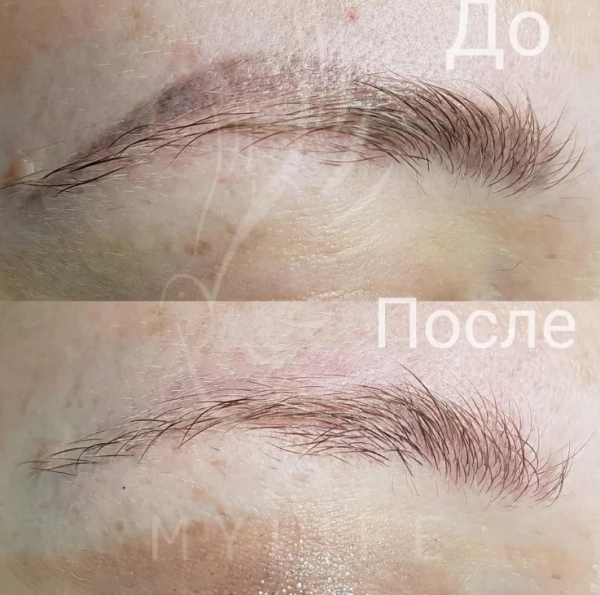Удаление татуажа