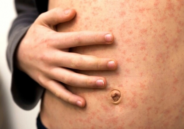 Зафиксировали коклюш и корь: какая эпидситуация в Одесской области 