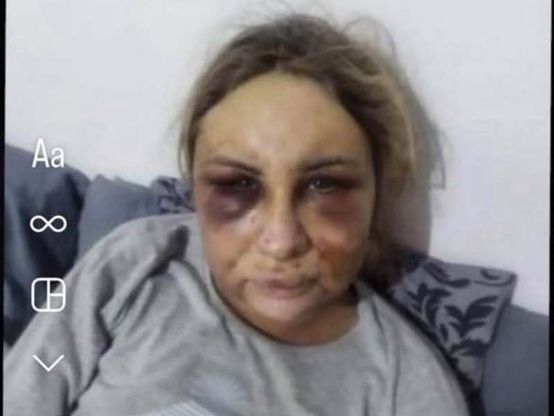 Після побиття у січні Віка пожаліла Юрія і забрала заяву з поліції: суд арештував 18-річного підозрюваного у вбивстві 27-річної буковинки